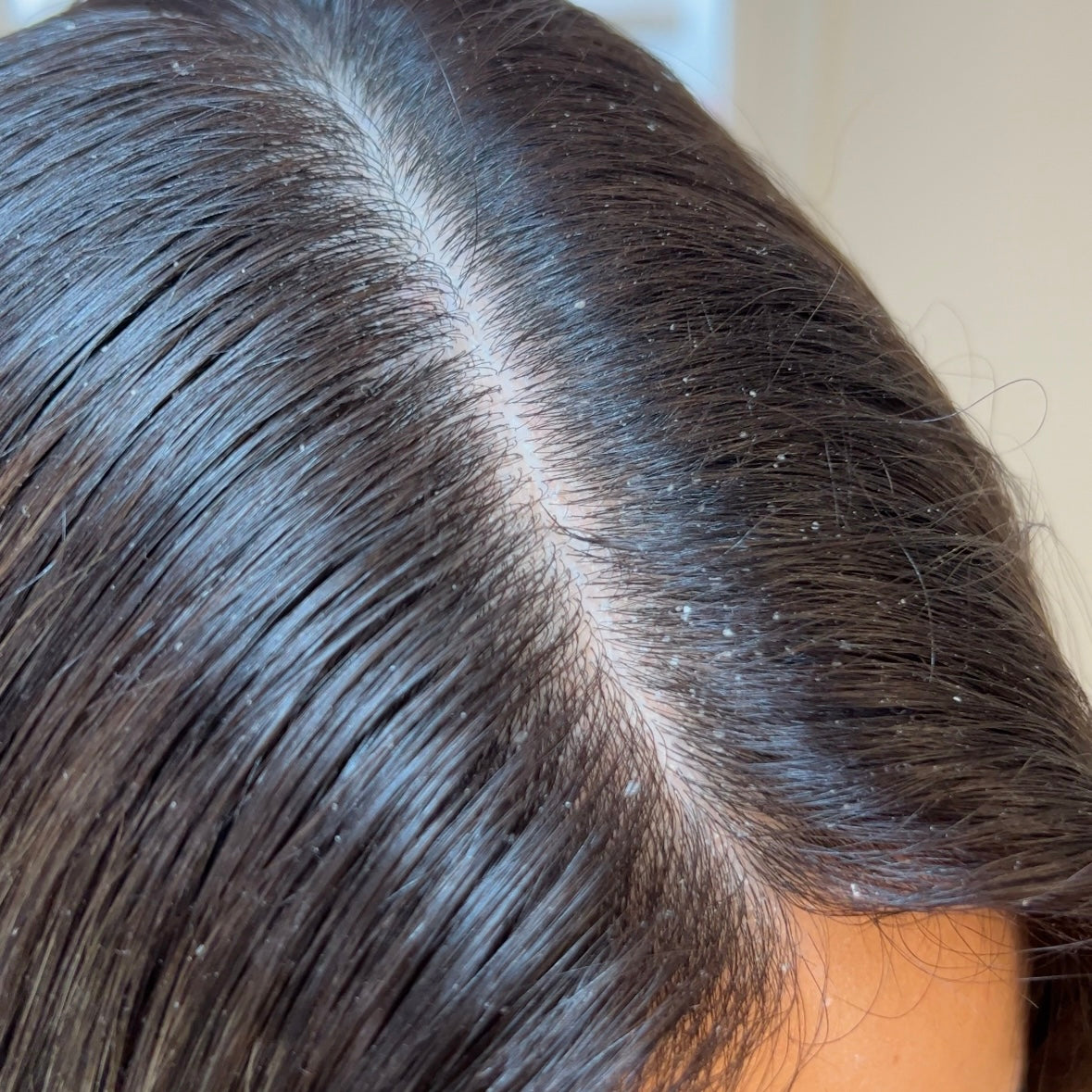 Relieves dandruff and itchiness