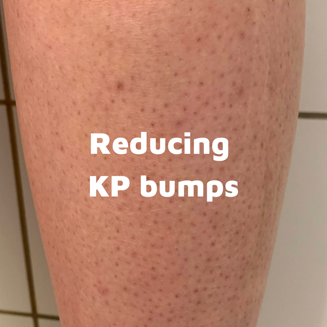 How to Treat Keratosis Pilaris