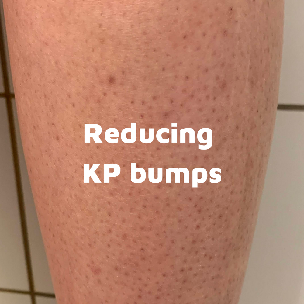 How to Treat Keratosis Pilaris Dewy Hours